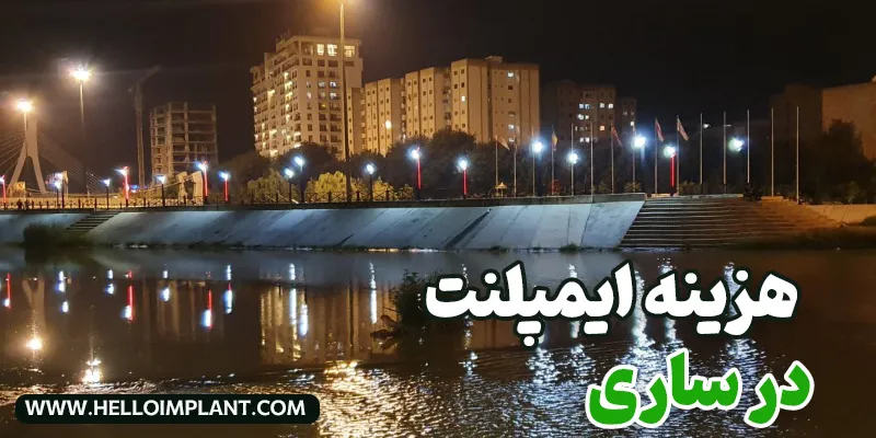قیمت ایمپلنت دندان در ساری چقدر است؟