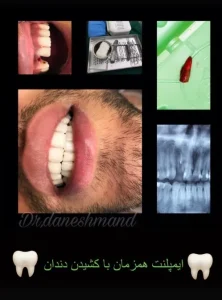 نمونه کارهای کاشت ایمپلنت دکتر مهران دانشمند در شهرکرد