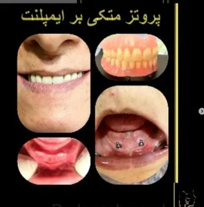 نمونه کارهای کاشت ایمپلنت دکتر مهران دانشمند در شهرکرد