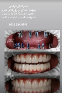 نمونه کارهای کاشت ایمپلنت دکتر مهران دانشمند در شهرکرد