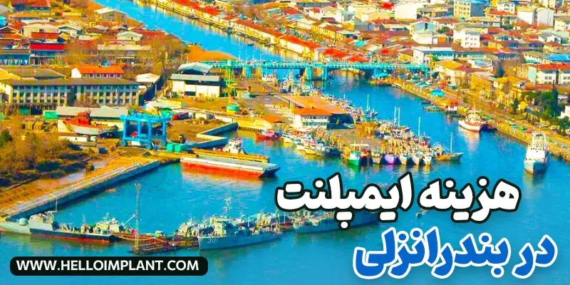 قیمت ایمپلنت در بندر انزلی 