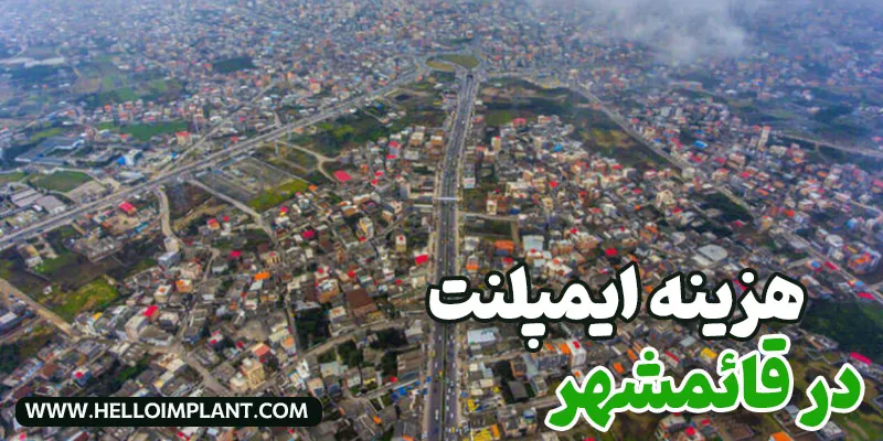 قیمت ایمپلنت دندان در قائمشهر