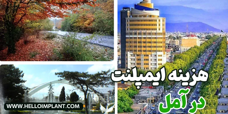 قیمت ایمپلنت دندان در امل چقدر است؟