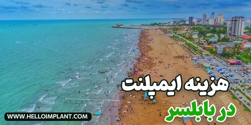 قیمت ایمپلنت در بابلسر چقدر است؟