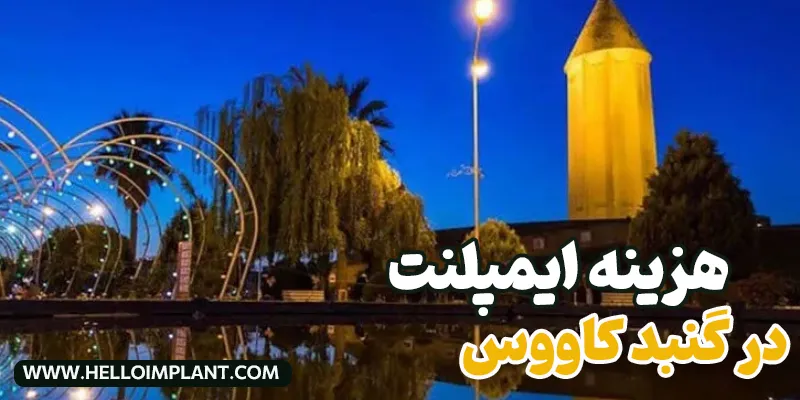  قیمت ایمپلنت دندان در گنبد کاووس چقدر است؟