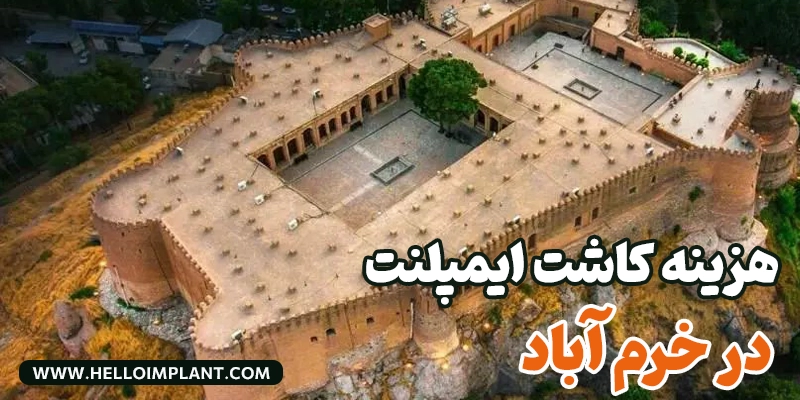 هزینه کاشت ایمپلنت خرم‌ آباد - قیمت ایمپلنت دندان خرم آباد استان لرستان- قیمت کاشت هرواحد ایمپلنت در خرم آباد لرستان چقدر است؟