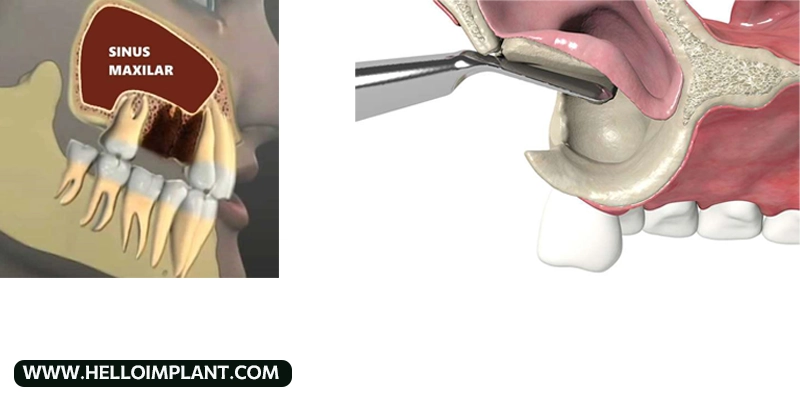 عوارض عمل سینوس لیفت