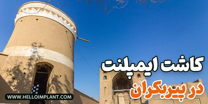 بهترین دکتر ایمپلنت پیربکران؛ لیست متخصصین و مراکز کاشت دندان