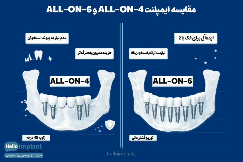 All-on-X | راهنمای کاشت دندان ثابت All−on−4 و All−on−6