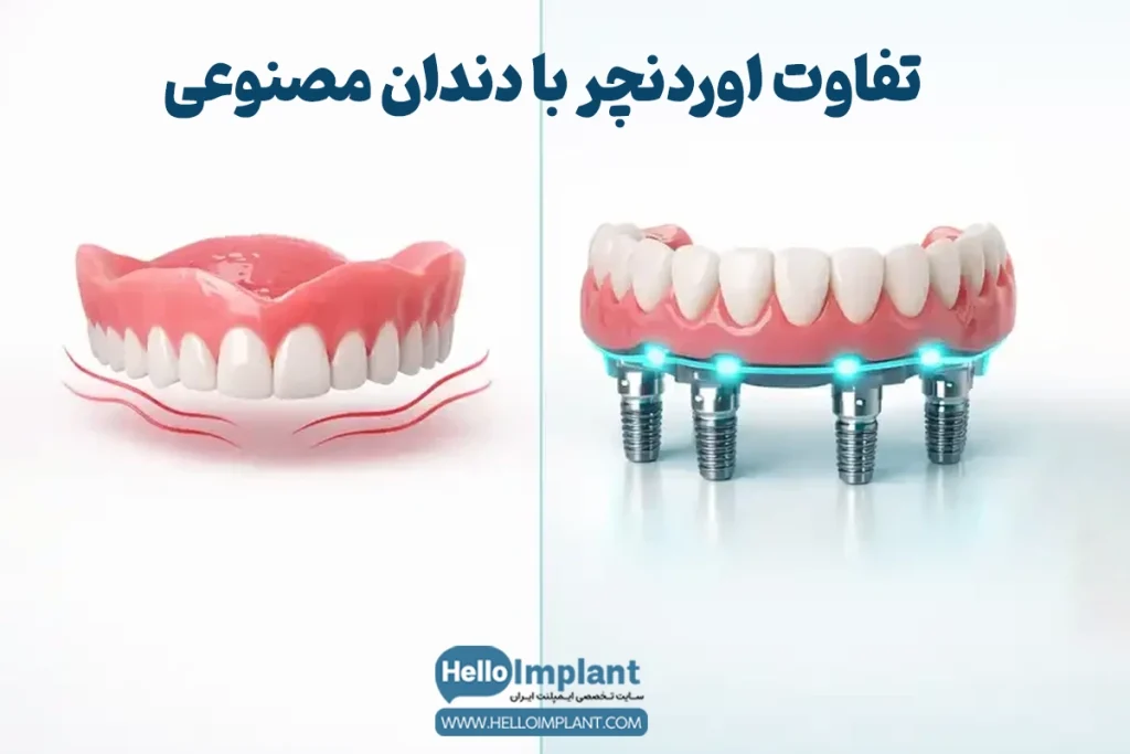 مقایسه اوردنچر با دندان مصنوعی سنتی و ایمپلنت ثابت (All-on-X)