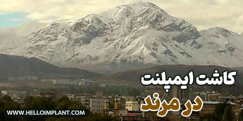 بهترین متخصص ایمپلنت در مرند